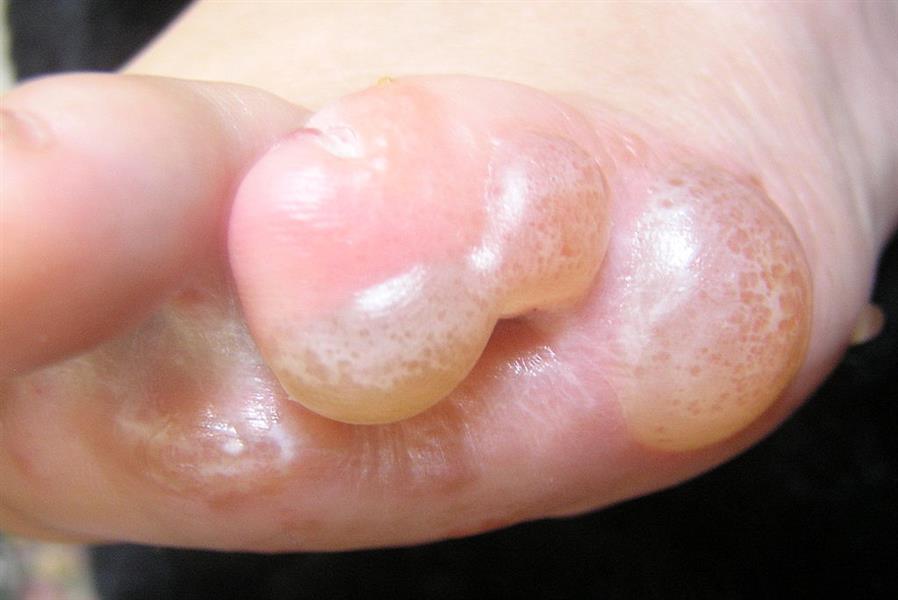 Complex dermatitis Complex dermatitis